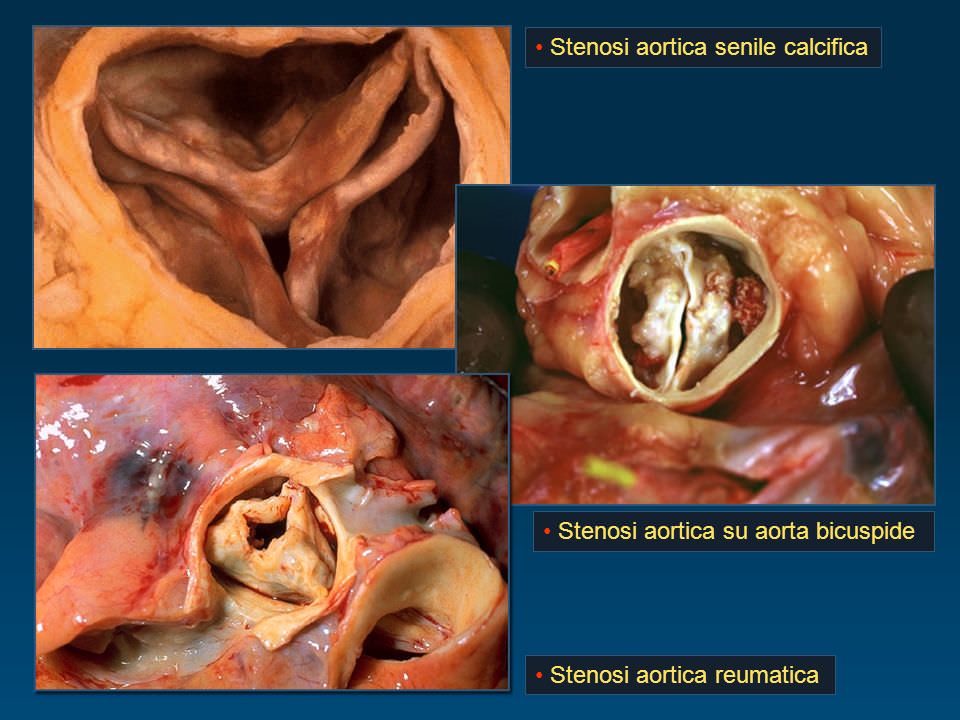 La stenosi della valvola aortica degenerativa dell’anziano