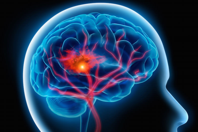 La terapia medica per la prevenzione dell’ictus cerebrale
