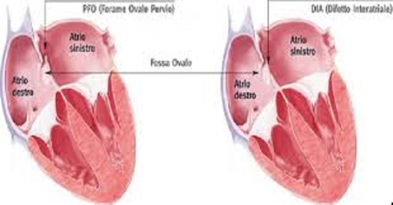 Il forame ovale pervio (PFO): un dilemma