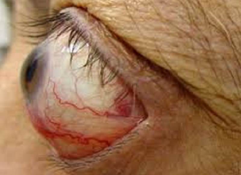 Le complicanze oculari dell’ipertiroidismo Le complicanze oculari dell’ipertiroidismo