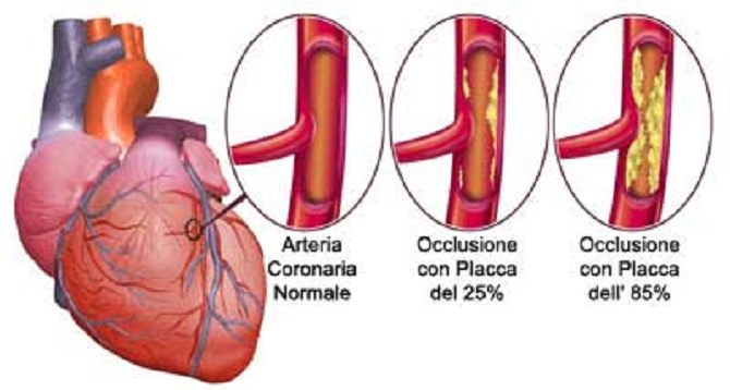 L’infarto miocardico acuto