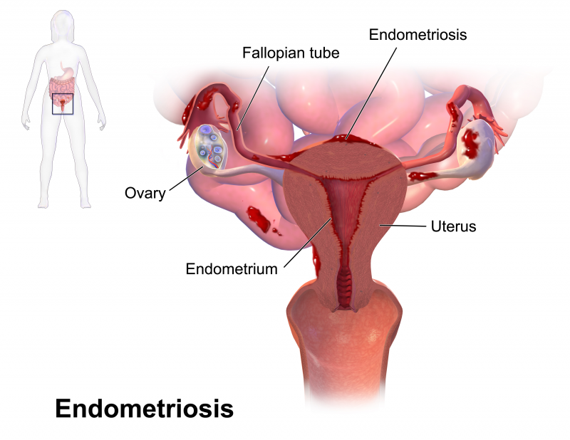 Endometriosi: dieta e stili di vita