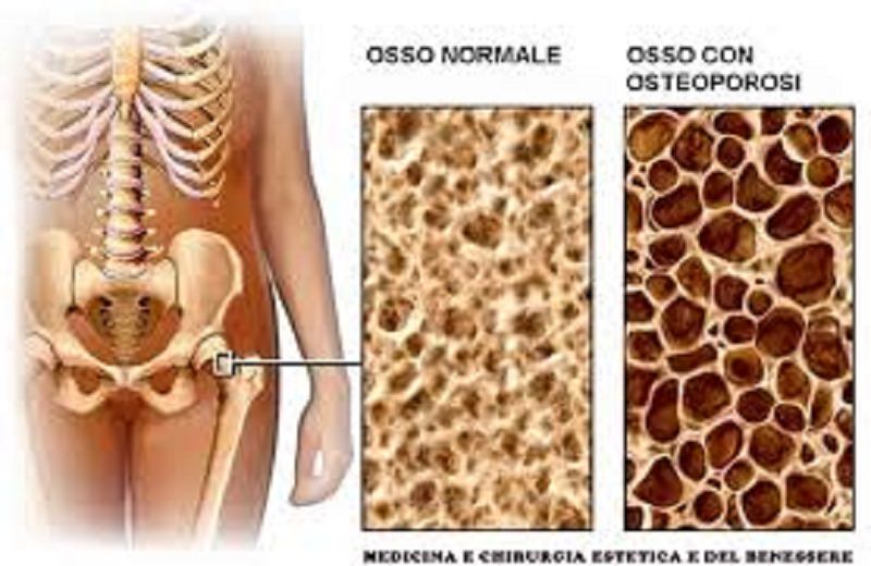 Osteoporosi e artrite reaumatoide