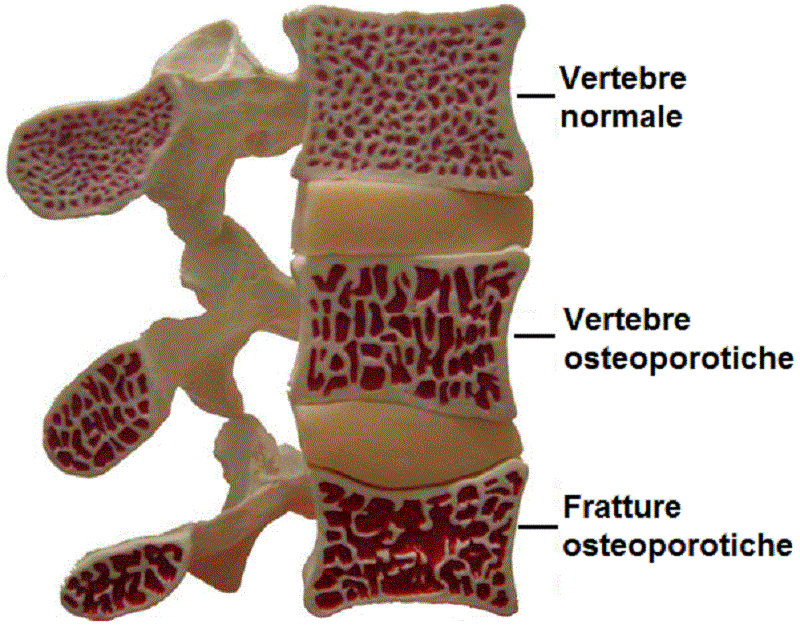 Caso osteoporosi: la nota del coordinatore provinciale Sindacato Medici Italia