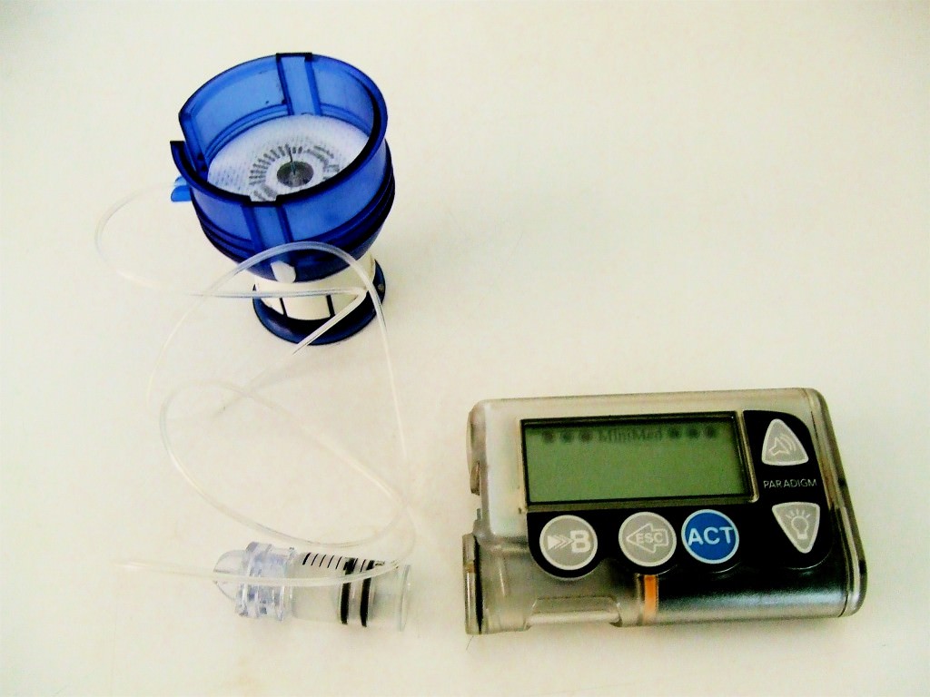Diabete, tutto sul microinfusore di insulina