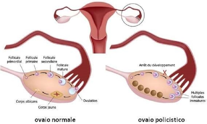 Ovaio policistico: nemico solo delle adolescenti?