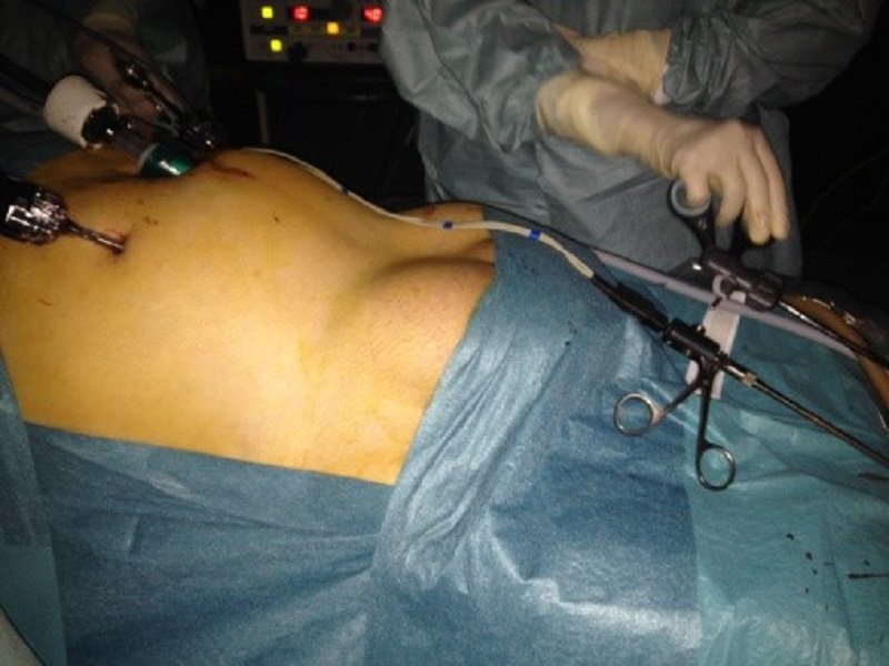 La chirurgia laparoscopica nel trattamento delle ernie inguinali