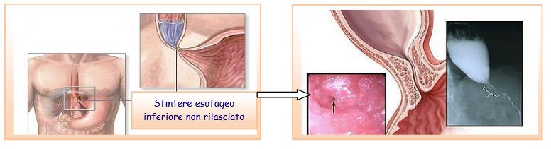 L’acalasia esofagea