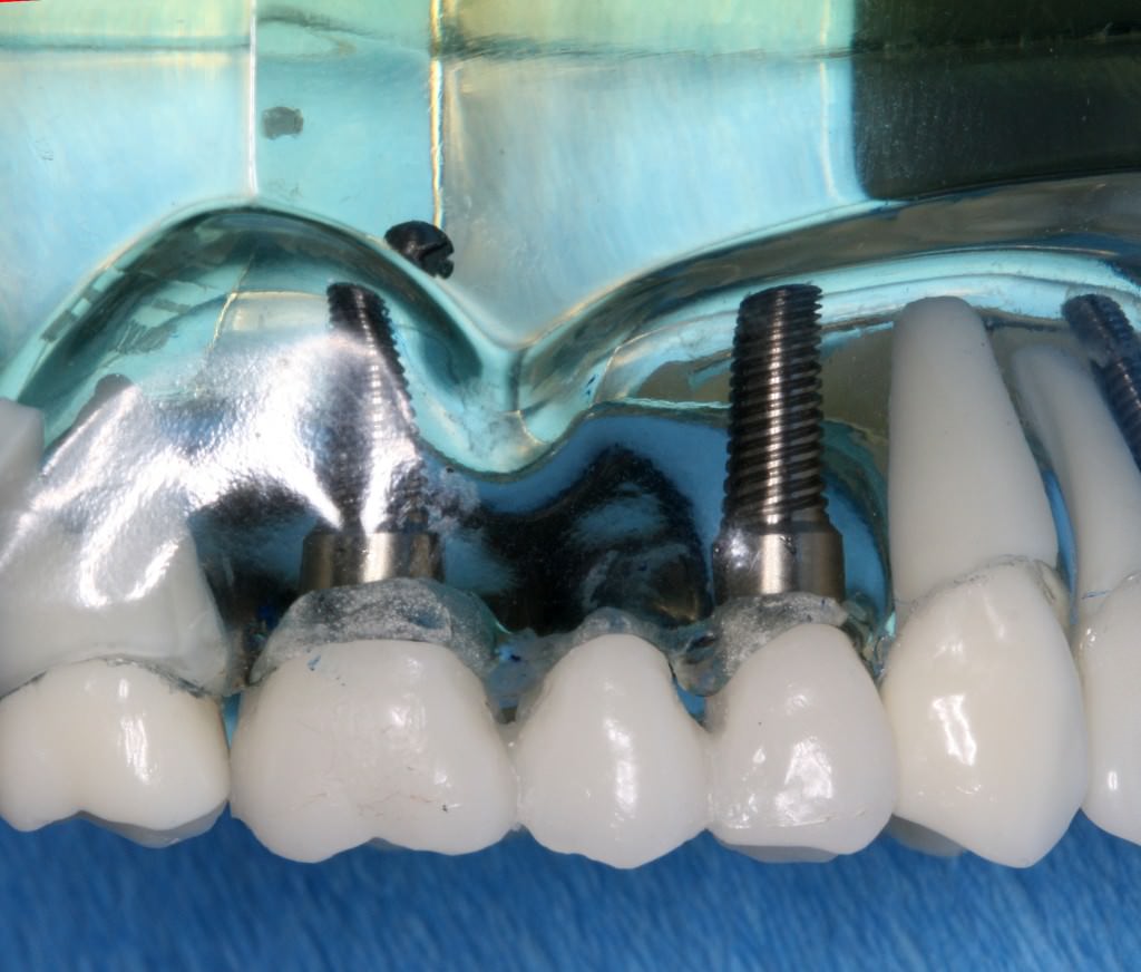 Impianti dentali e ipercolesterolemia