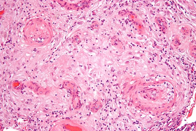 Preeclampsia: sempre più diffusa e meno riconosciuta