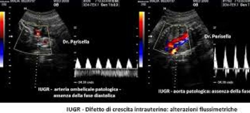 Difetto di crescita intrauterino