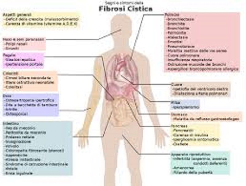 Fibrosi cistica, dalla malattia al trapianto. Gli strumenti in Sicilia Fibrosi cistica, dalla malattia al trapianto. Gli strumenti in Sicilia