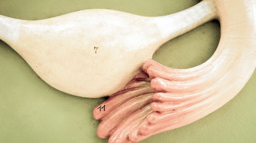 Malattia infiammatoria della pelvi