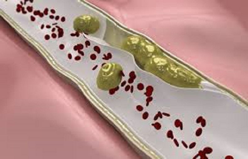 L’embolia arteriosa: definizione e diagnosi