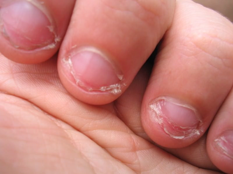 Mangiarsi le unghie, è pericoloso?