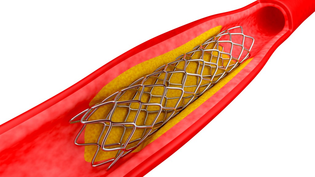 I farmaci antinfiammatori fanno male al soggetto portatore di stent?