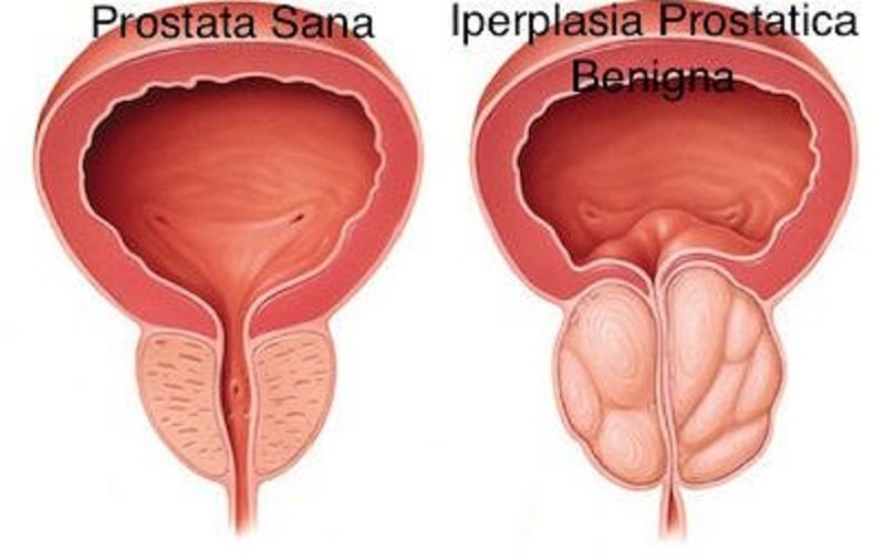 Prostatite. Ma a cosa serve la prostata?