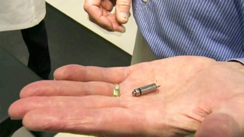 Mini peacemaker impiantanto a Ragusa per la prima volta al mondo