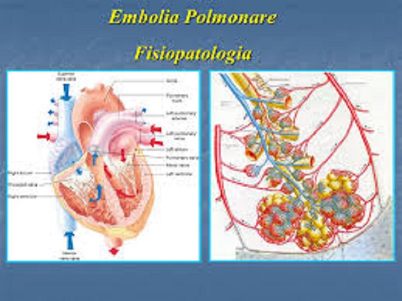 Come prevenire l’embolia polmonare