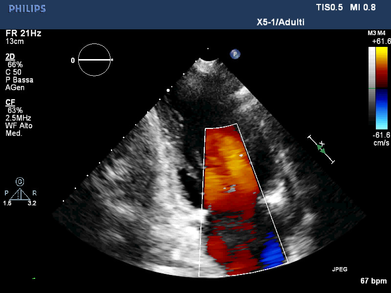 La stenosi aortica e l’ecocardiografia