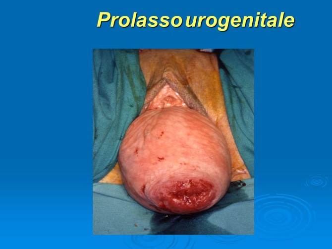 Prolasso Uterino Come Riconoscerlo E Quali Sono Le Cure The Best Porn