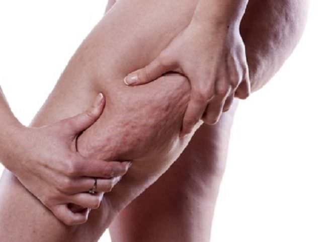 Un “cuscinetto” assai scomodo: la cellulite