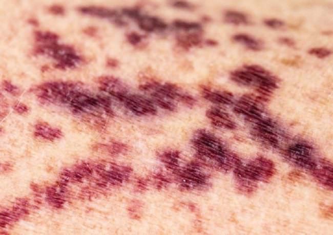Ematoidrosi, 21enne suda sangue da mani e viso