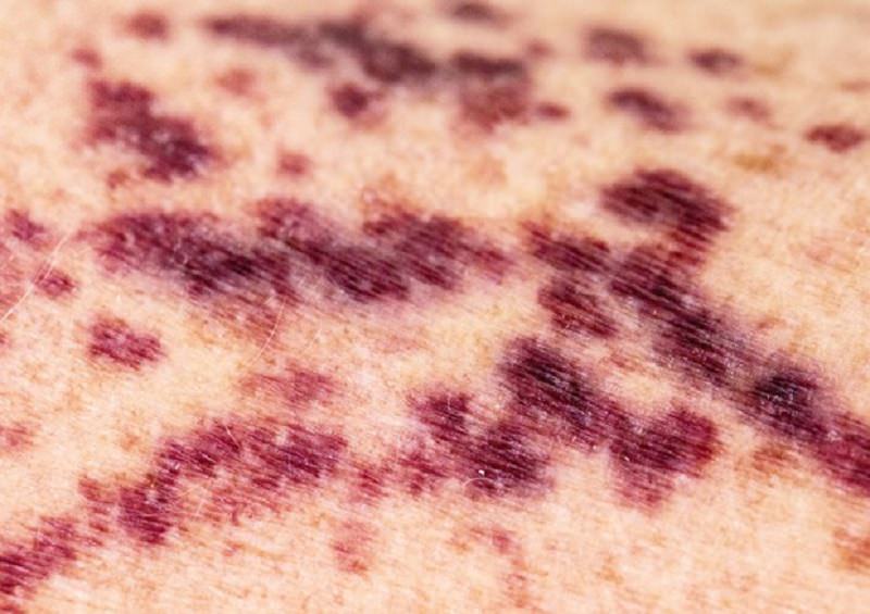 Ematoidrosi, 21enne suda sangue da mani e viso