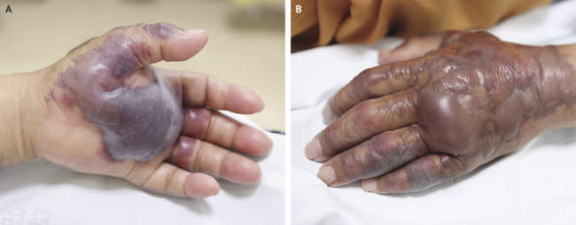 Sushi contaminato in un ristorante, contrae un’infezione e gli viene amputata la mano sinistra – FOTO