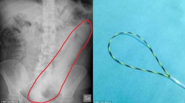 Dildo nel retto per 24 ore: uomo finisce in ospedale con sex toy da 60 centimetri