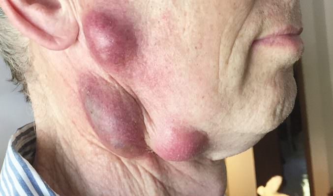 Ringonfiamenti sul collo e febbre: 68enne contrae la “febbre dei conigli”