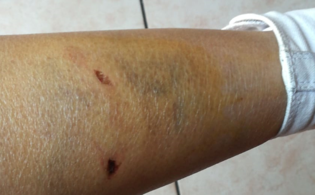 Lavoratrice del Policlinico di Catania aggredita dai randagi della zona. FIALS Catania chiede più sicurezza