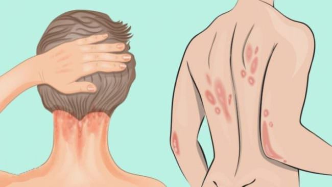 Una “convivenza eterna” nel proprio corpo: la psoriasi come “nemica per la pelle”