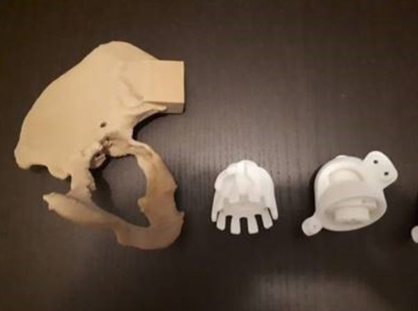 Protesi all'anca in 3d impiantata a Ferrara