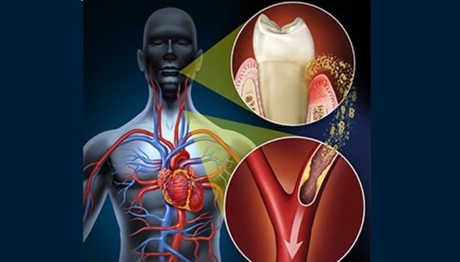 Danno cardiovascolare, uno studio sull’influenza della parodontite: che correlazione c’è?