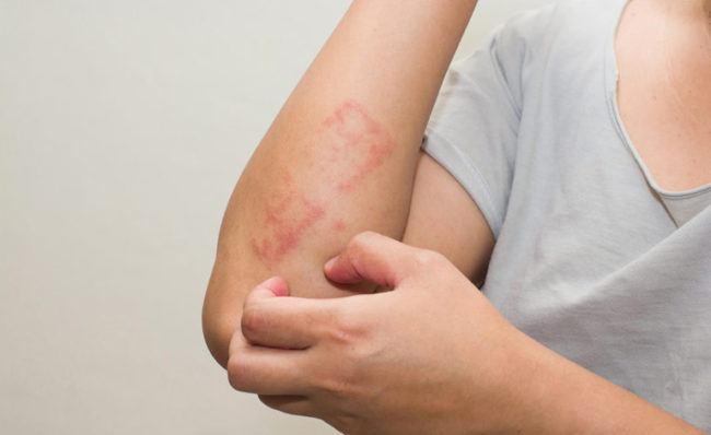 Psoriasi, un nuovo farmaco ottiene la rimborsabilita' dall'Aifa