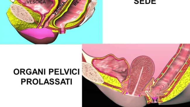 L’utero prolassato va conservato, la tecnica POPS