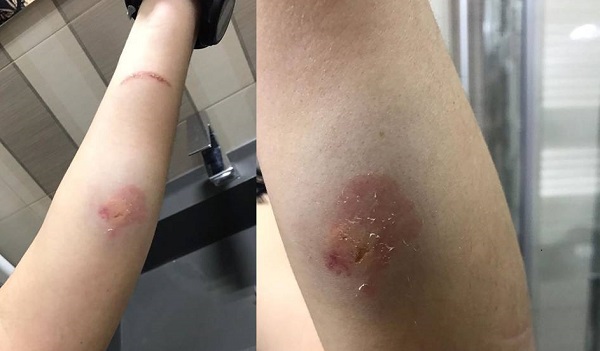 Infermiera aggredita in ospedale, morsa al braccio da paziente 19enne: presentata denuncia