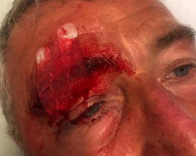 Un gavettone e una violenta rissa: ex deputato Girolamo Fazio in ospedale