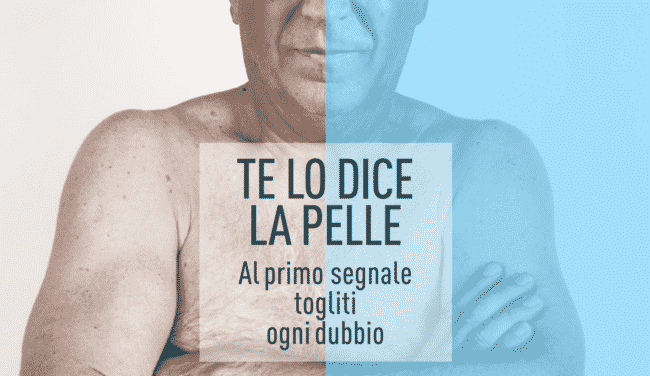 Carcinoma squamocellulare cutaneo: a Catania visite di screening gratuite sul tumore della pelle