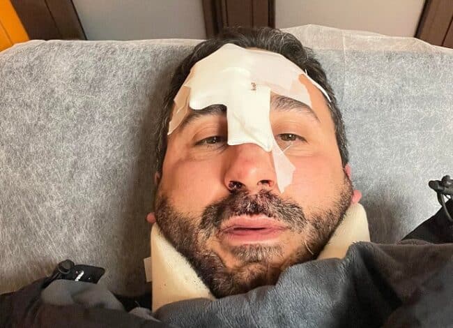 Lo chef Natale Giunta si rompe il naso cadendo dal monopattino a Palermo: lo sfogo sui social