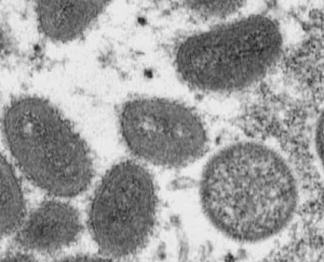 Vaiolo delle Scimmie, due casi sospetti in Sicilia: analisi in corso