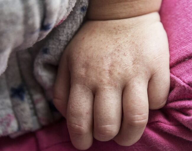 Boom di casi di Streptococco A in Europa, alcuni con esiti mortali: genitori preoccupati per i loro figli