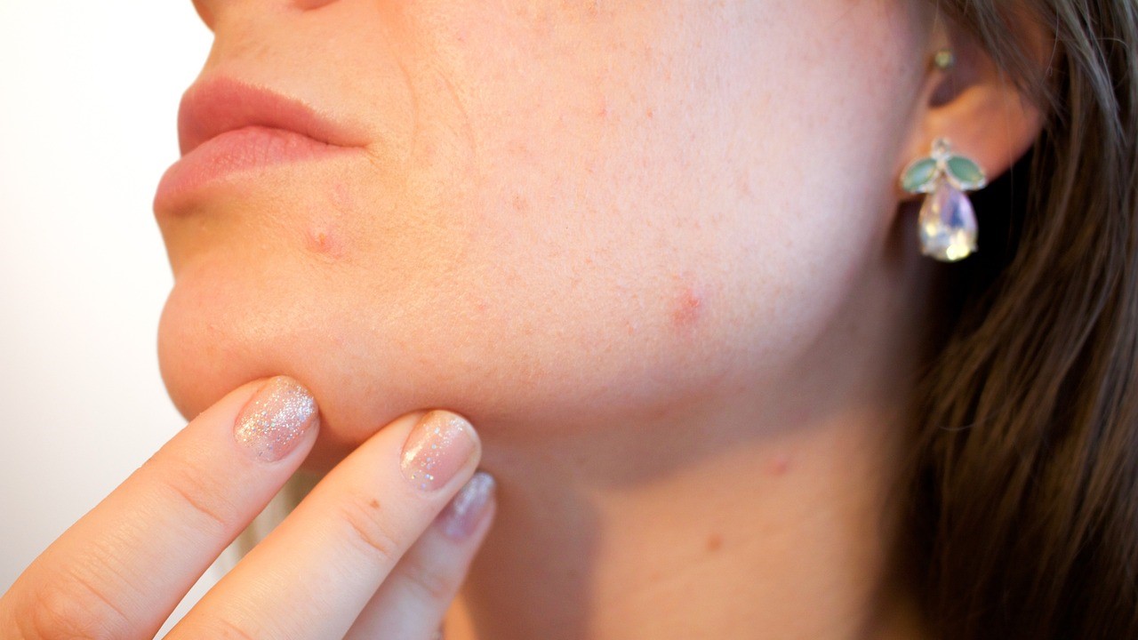 Come trattare l’acne in estate: i consigli della dermatologa Laura Alessi