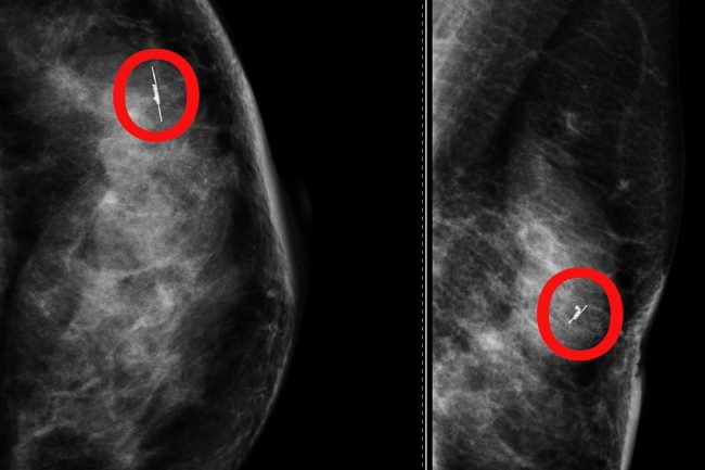 Al Cannizzaro un “radar” per individuare anche i più piccoli noduli al seno