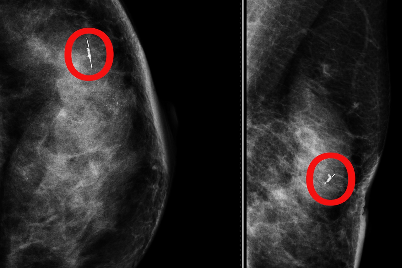 Al Cannizzaro un “radar” per individuare anche i più piccoli noduli al seno