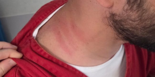 Infermiere strangolato durante il turno: nuova aggressione in ospedale