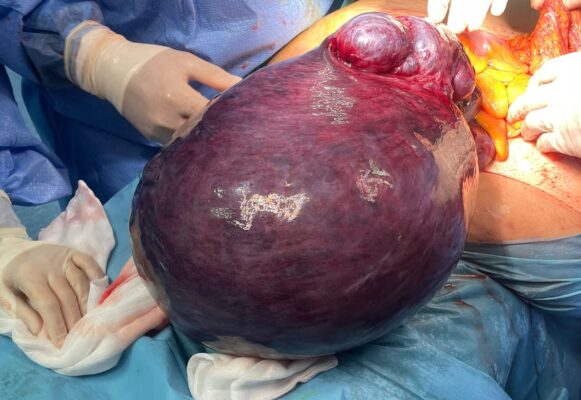 Marsala, asportato un fibroma dell’utero di 16 chili: intervento d’urgenza su una donna di 54 anni